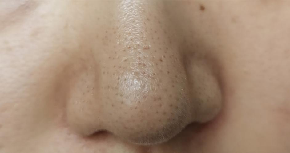 医院皮肤科医生怎样祛除黑头,医生黑头粉刺去除的过程