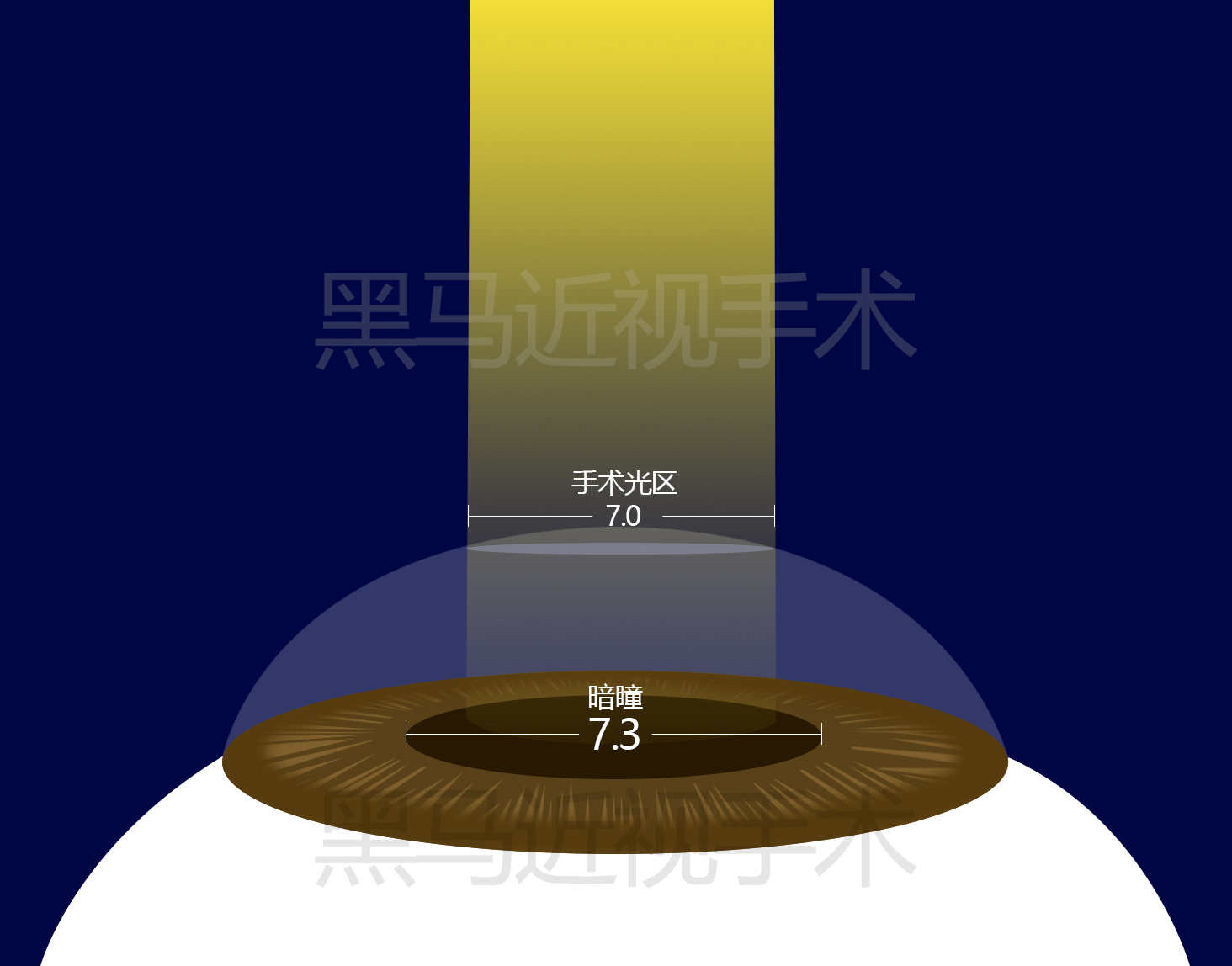 近视300度做激光手术会有后遗症吗,激光近视手术的后遗症有哪些知乎