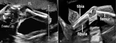 做彩超四维正常胎儿无畸形吗,胎儿脊柱超声几周做
