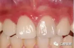 门牙撞了怎么办,门牙碎了你怎么办