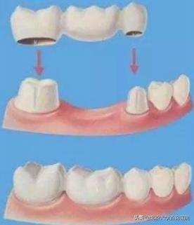 牙列缺损与牙体缺损,牙体缺失和牙列缺损区别