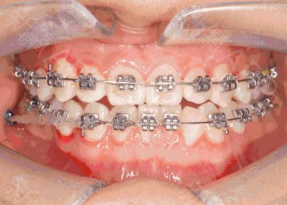 30岁还可以牙齿矫正吗,30岁牙齿矫正一般多少钱