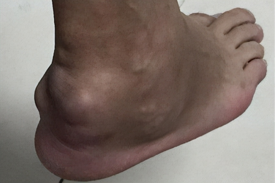 痛风都有哪些好发部位？脚背痛是痛风发作了吗？