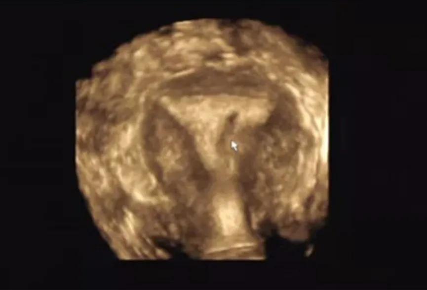 关爱女性|呵护子宫,不可忽视“宫腔粘连”