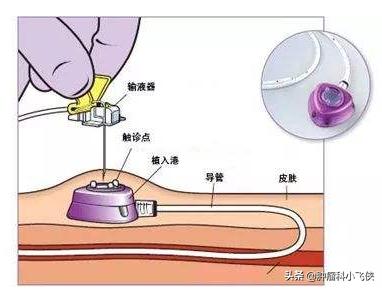 化疗埋管保证治疗顺利进行,一旦药物外渗患者遭罪又耽误治疗