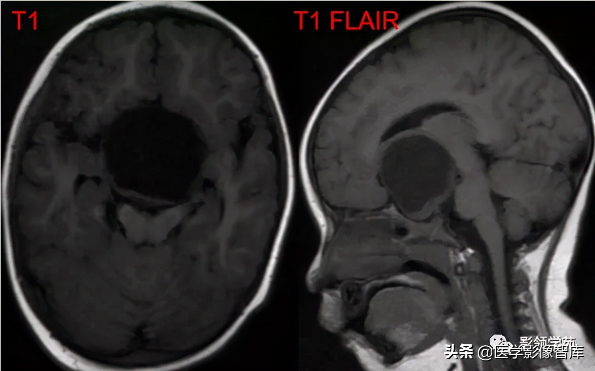 鞍区肿瘤做什么检查得出来,鞍区肿瘤的影像学鉴别