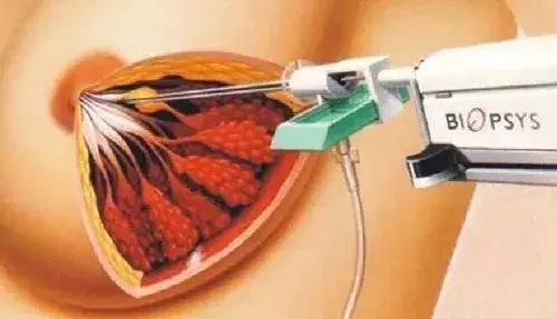 乳房肿块和纤维腺瘤,乳腺纤维腺瘤肿块有无血流信号