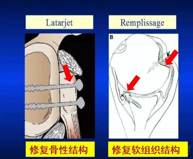 习惯性肩关节脱臼如何改善,肩关节脱位容易形成习惯性脱位吗