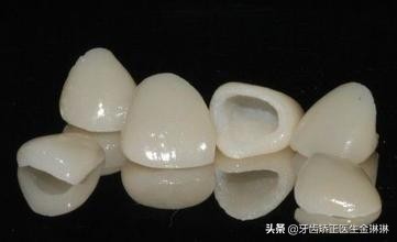 山东烤瓷牙修复,淄博烤瓷牙好不好