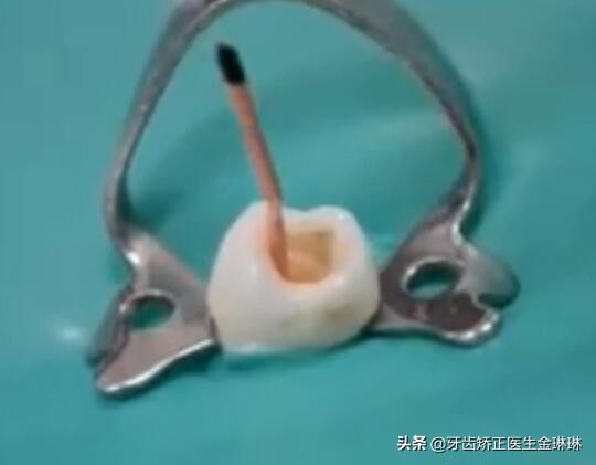 小蛀牙补牙,小蛀牙可以修复吗