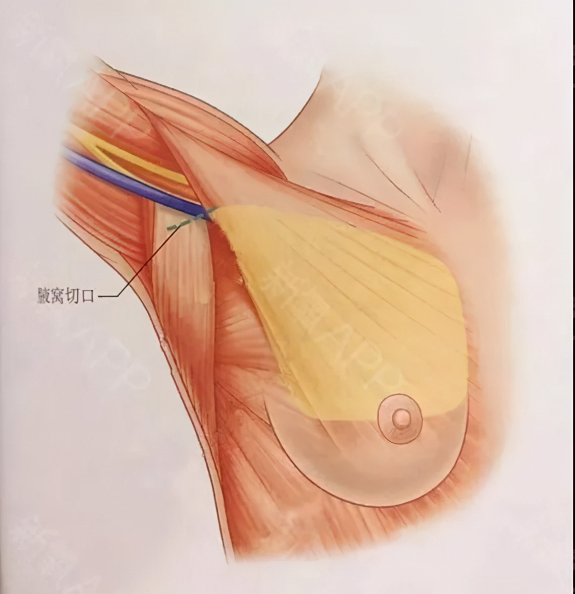 26岁女子隆胸命丧手术台,女子隆胸手术出意外后续