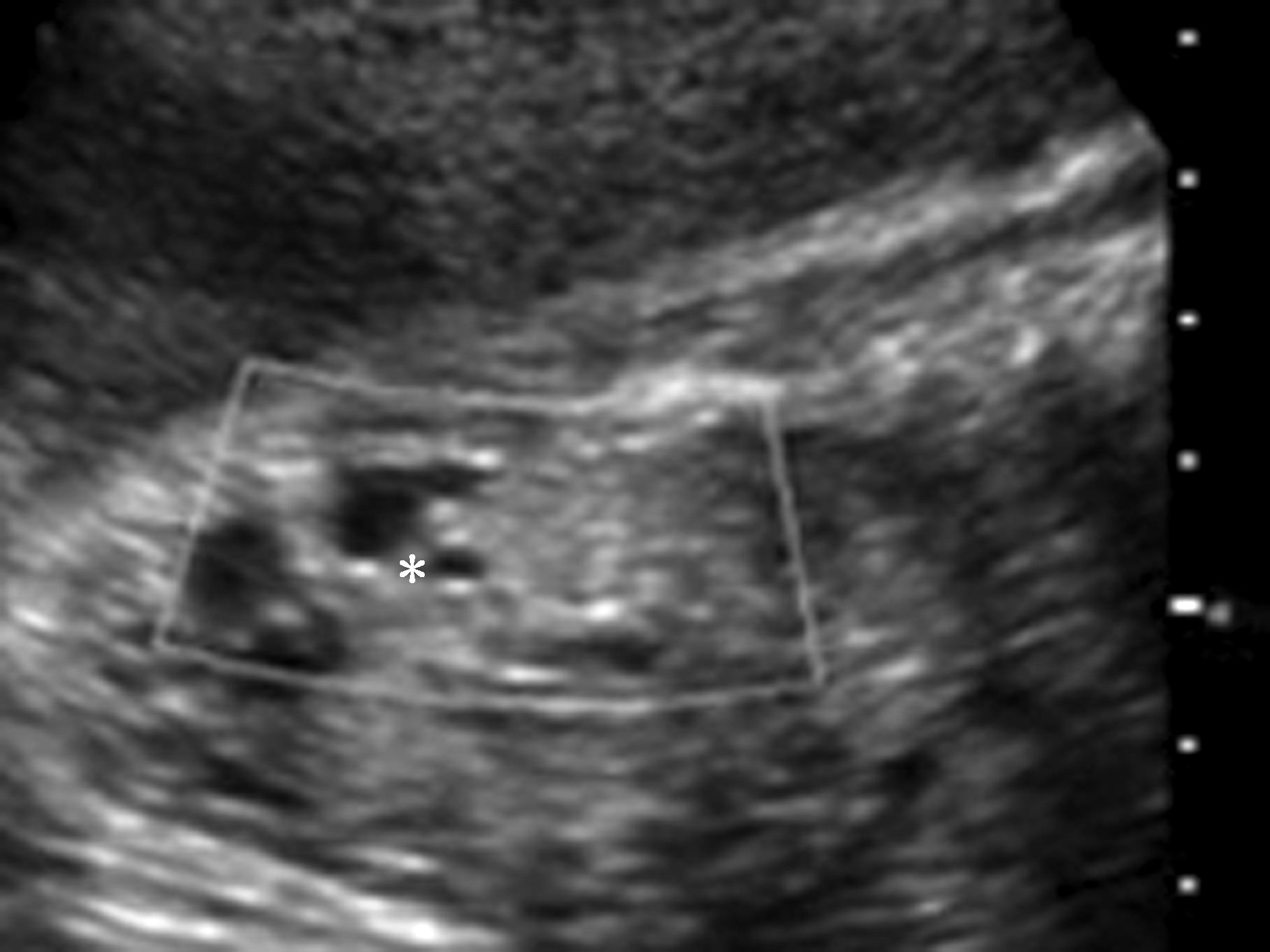 彩超泌尿系统显示都正常,胎儿肾囊性疾病分型