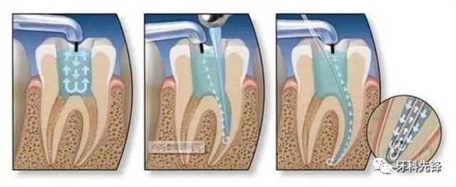根管治疗做冠的牙齿会裂开吗,根管治疗后牙齿裂了还能做外冠吗