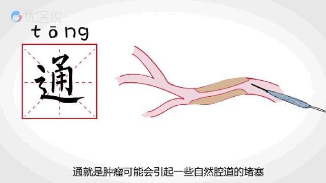 肿瘤微创介入是什么,肝恶性肿瘤微创介入手术全过程