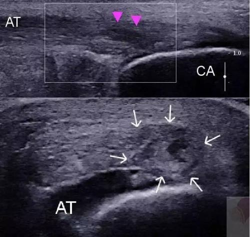 跟腱断裂轻度功能障碍鉴定标准,跟腱出现问题前有什么表现