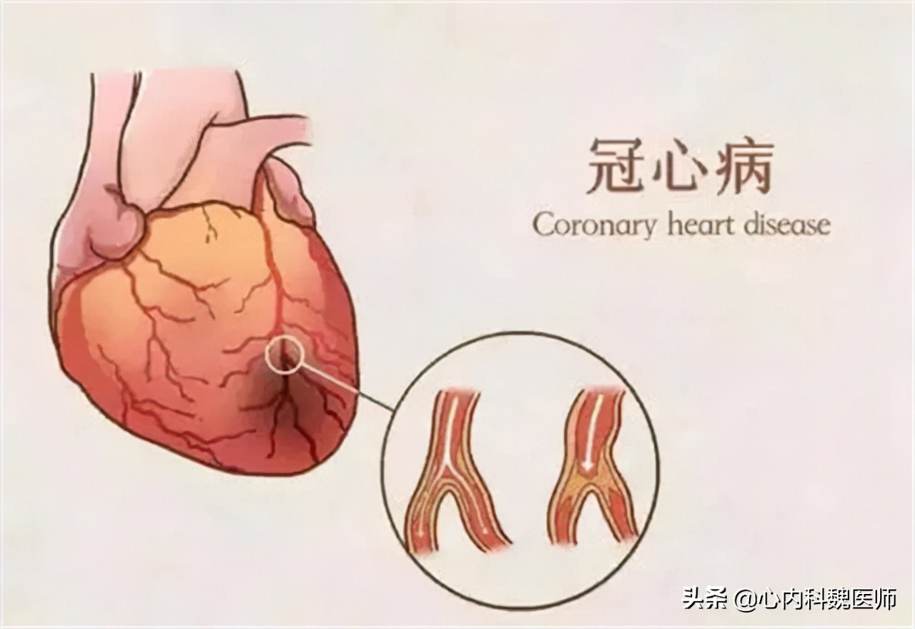 冠心病吃什么药预防心梗,心梗冠心病预后