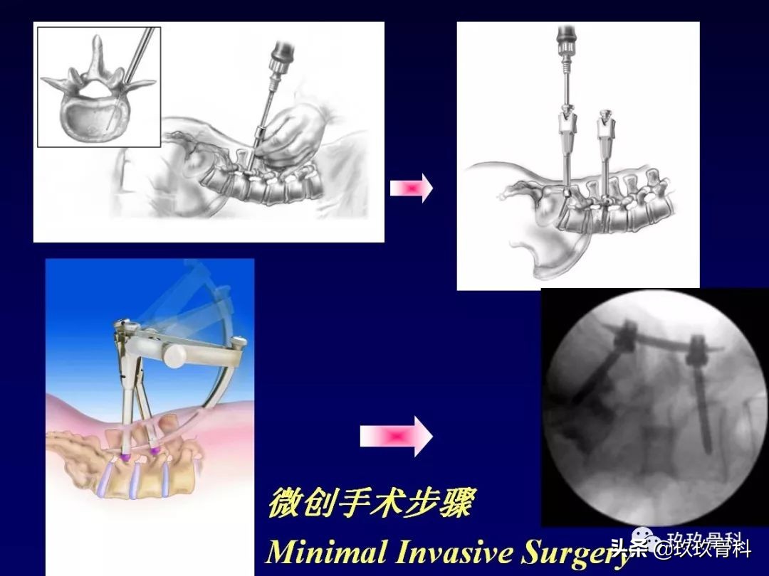 腰椎不稳最坏的结果,腰椎不稳的最佳治疗方法