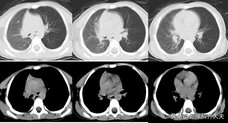 小儿气管镜怎么检查,小儿ct检查全过程视频