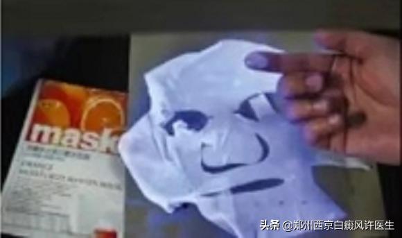 洛阳患者日常使用面膜，导致白斑扩散，这些危害你知道么？