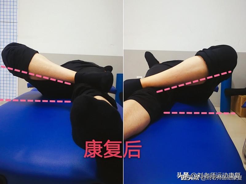 如何矫正xo腿型科学方法,康复科医生教你怎么矫正腿型