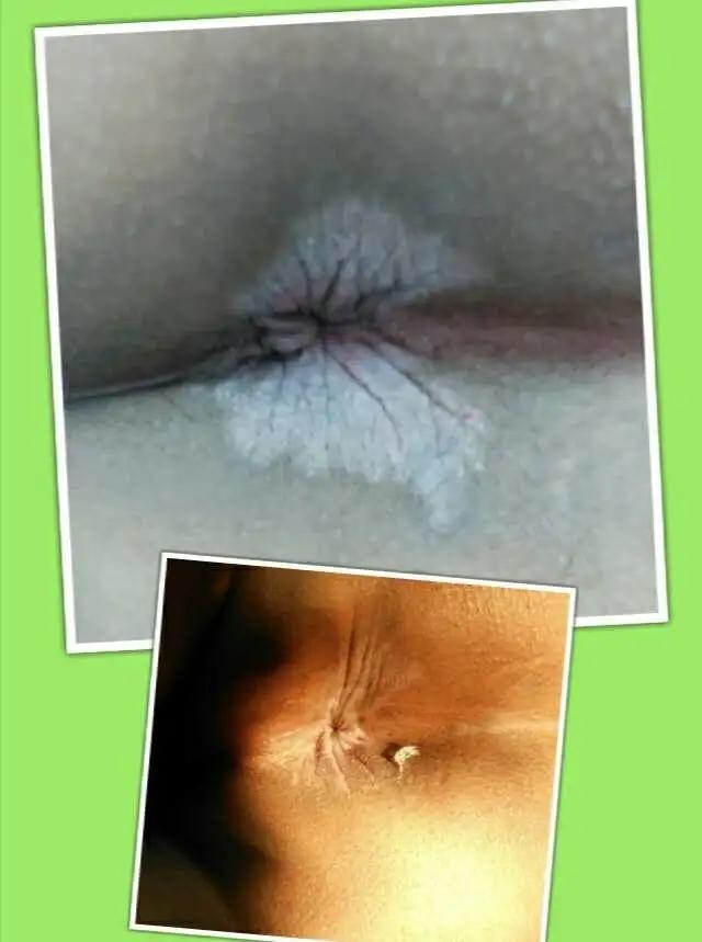 伤口好了后变成紫色,术后伤口颜色深