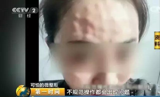 女子整容换脸后续,整容死亡真实案例