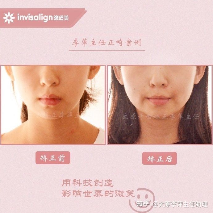 重度拥挤矫正牙齿适合隐形牙套吗,广州成人牙齿矫正推荐隐形牙套