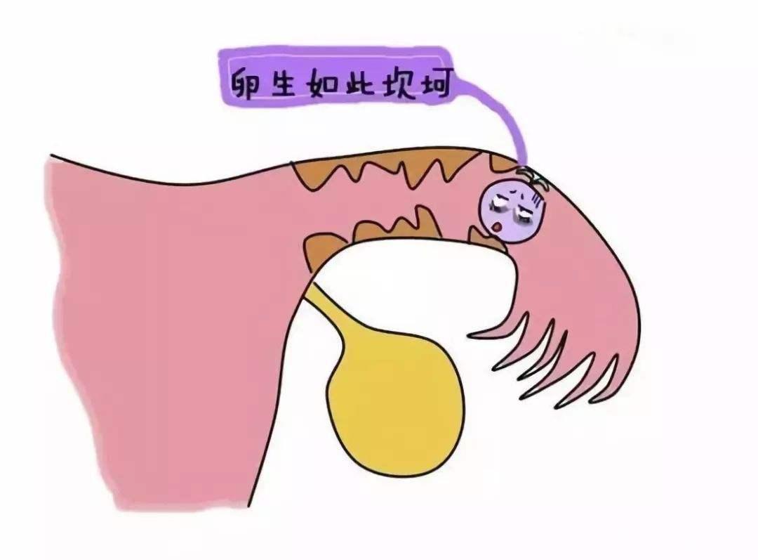 为什么感觉宫外孕那么常见，切了输卵管女性怎么办？