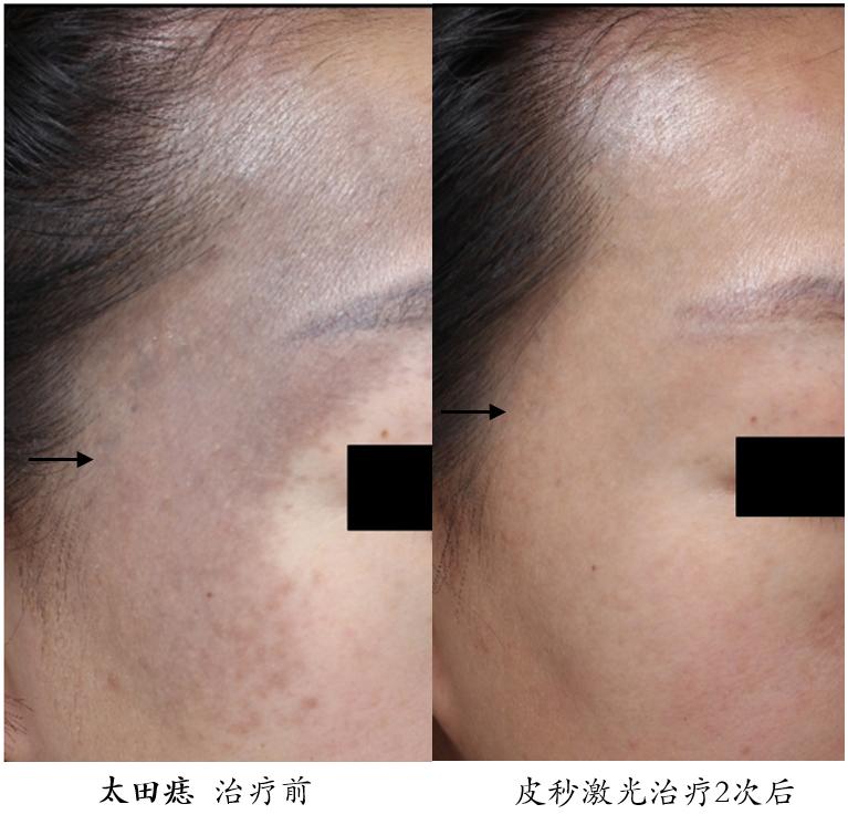 皮秒激光伤皮肤吗,皮秒激光能治凹陷疤痕吗