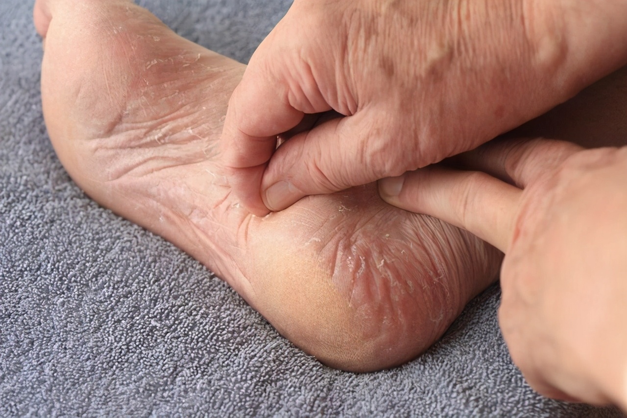 脚后跟开裂缺少哪种维生素,脚后跟干裂起皮是缺乏什么