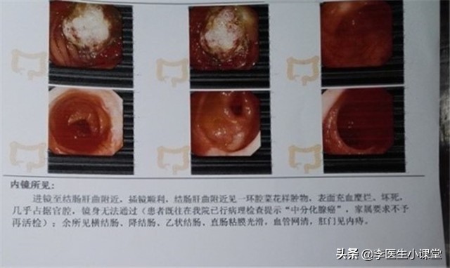 82岁老人便血半年检查肠癌,八十岁老人得肠癌总便血怎么办