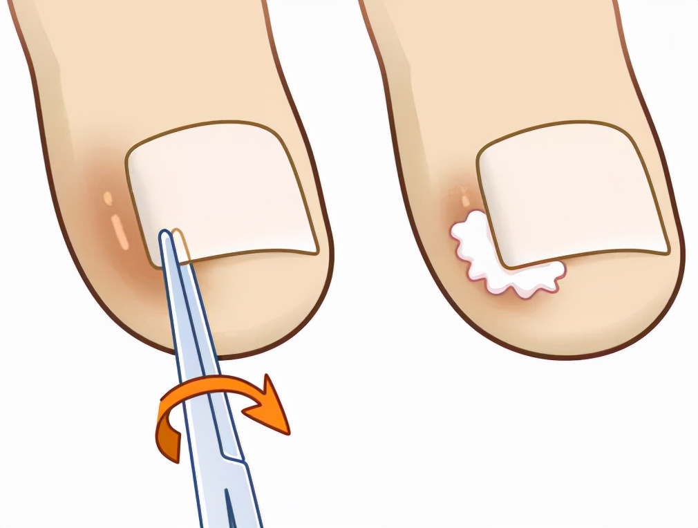 大脚趾头甲沟炎嵌甲钻心的痛,急性手指甲沟炎钻心疼痛