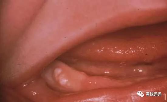 三岁孩子做根管治疗不配合,三岁小孩可以做根管治疗吗