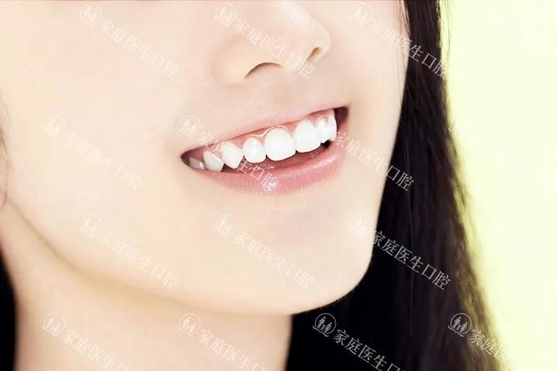 一般矫正牙齿是怎样去矫正的,牙齿矫正的几种牙齿类型和方案