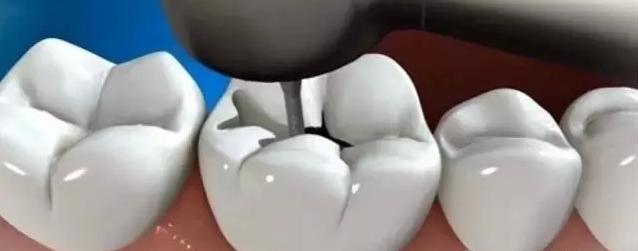 补牙学问,补牙真的是小洞不补大洞吃苦吗