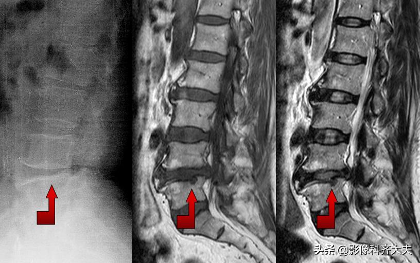 腰椎间盘突出最好的影像诊断方法,腰椎间盘突出的影像学检查