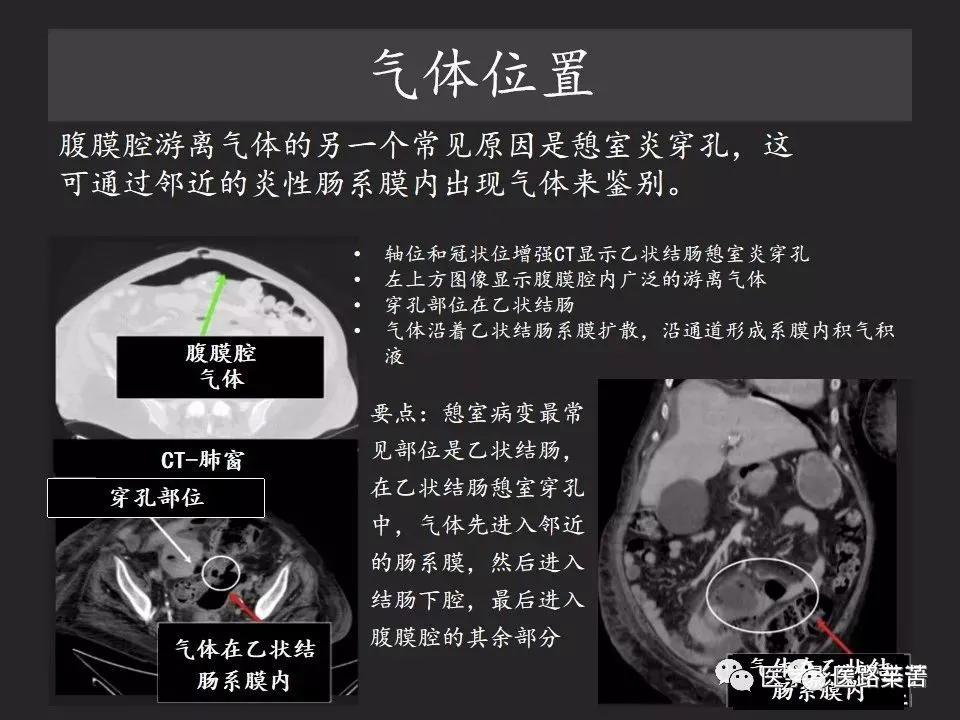 空腔脏器穿孔和胃肠道穿孔区别,腹膜后穿孔一般是哪里穿孔