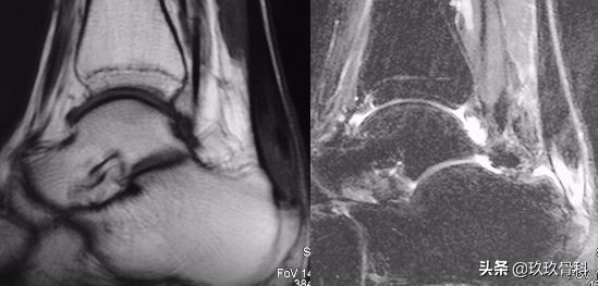 陈旧性踝关节损伤的治疗,踝关节损伤现场处理视频