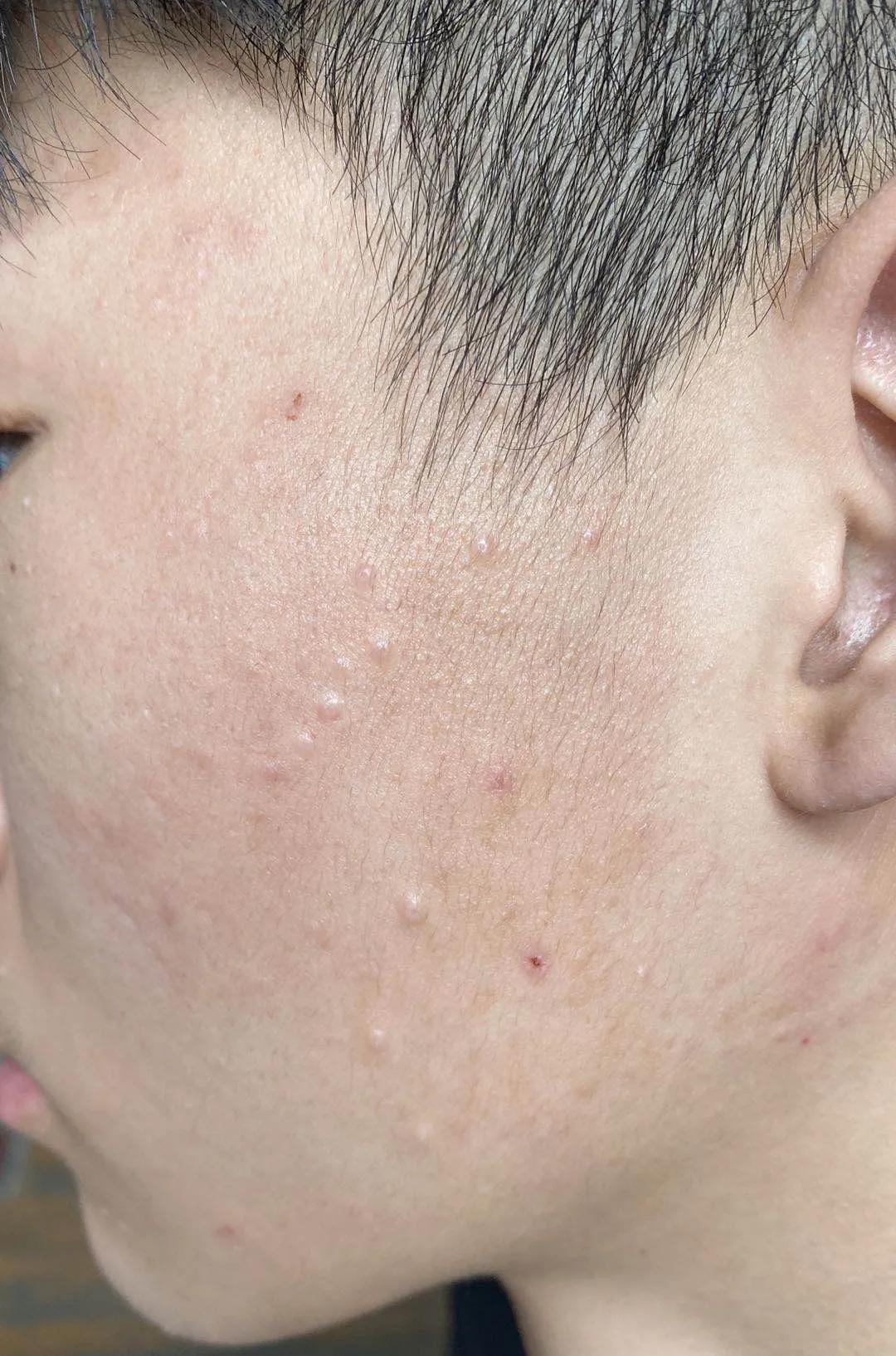 16岁男孩脸上长青春痘了怎么办,12岁男孩子脸上长满青春痘怎么办