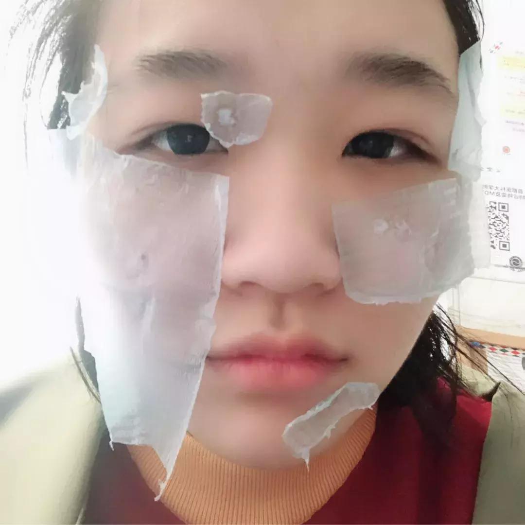 激光祛痣亲身经历和感受,激光祛痣亲身经历