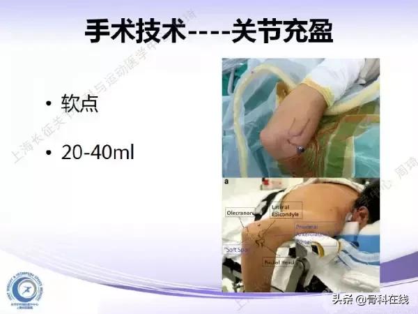 肘关节镜手术后引流,肘关节镜微创手术
