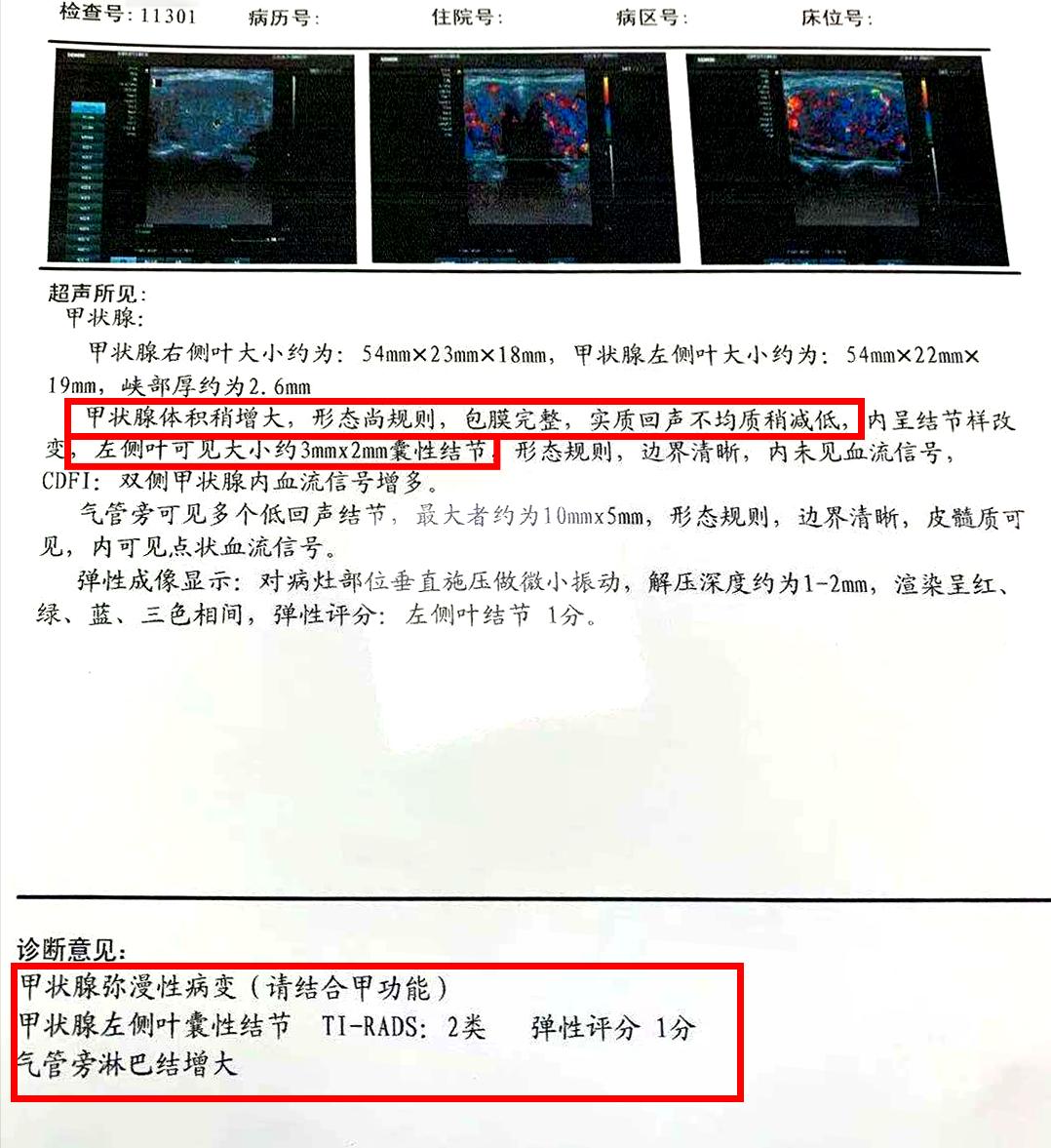桥本亚临床甲减喉咙发紧,亚临床桥本甲减脖子会疼吗