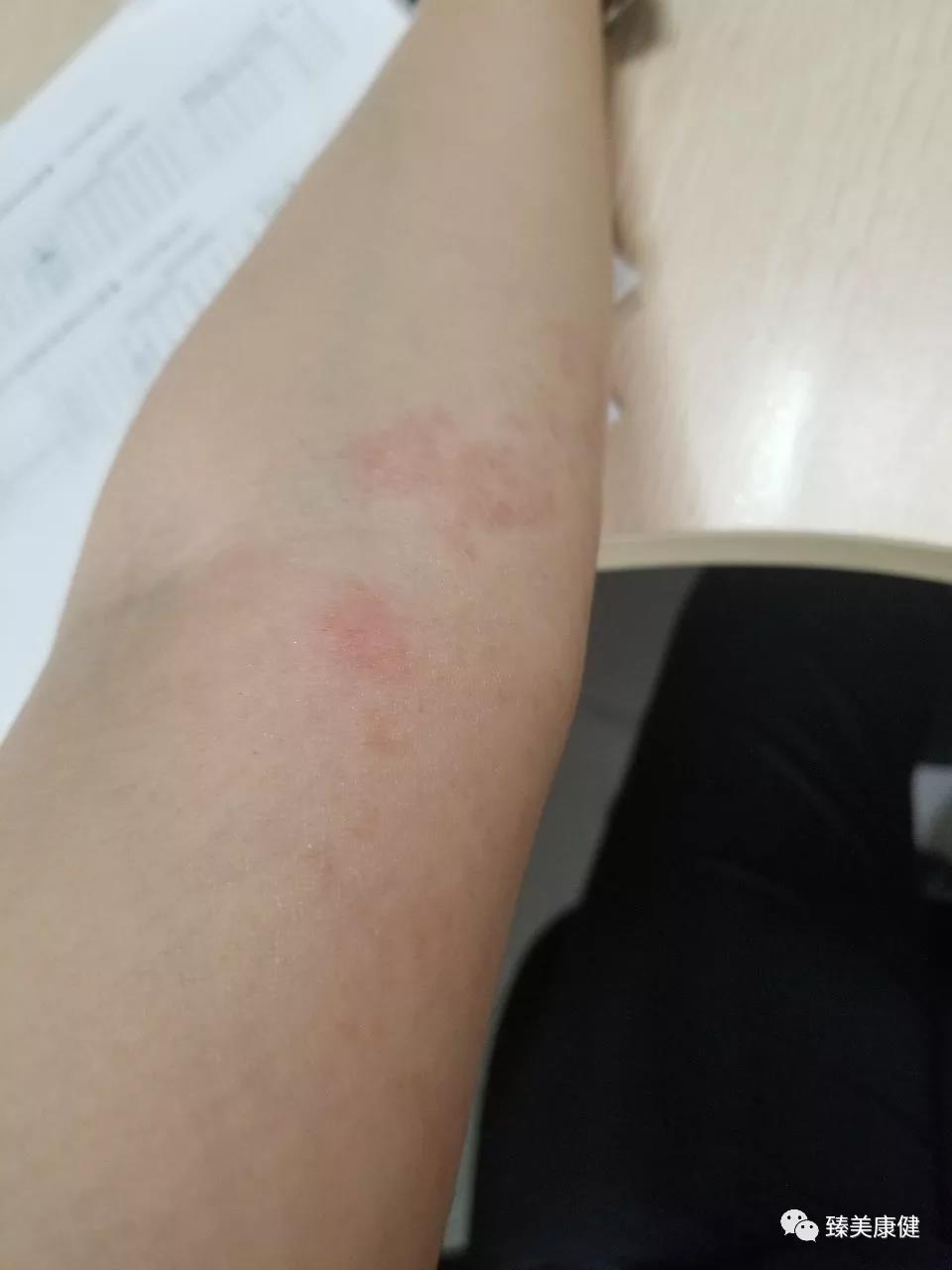 胃苓丸加什么药治湿疹,除湿胃苓丸治疗湿疹