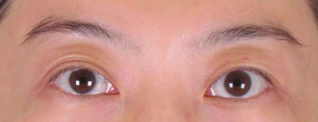 双眼皮整形修复,潘贰双眼皮修复