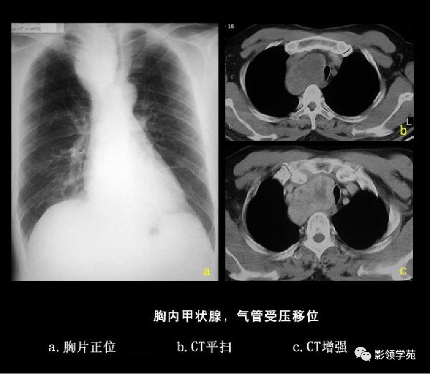 纵隔和肾上腺恶性肿瘤,纵隔性肿瘤位置图