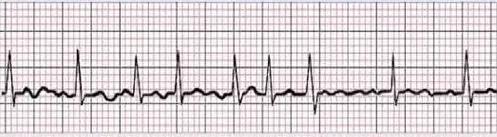 重症患者发生房颤如何处理,高血压合并房颤的急诊处理