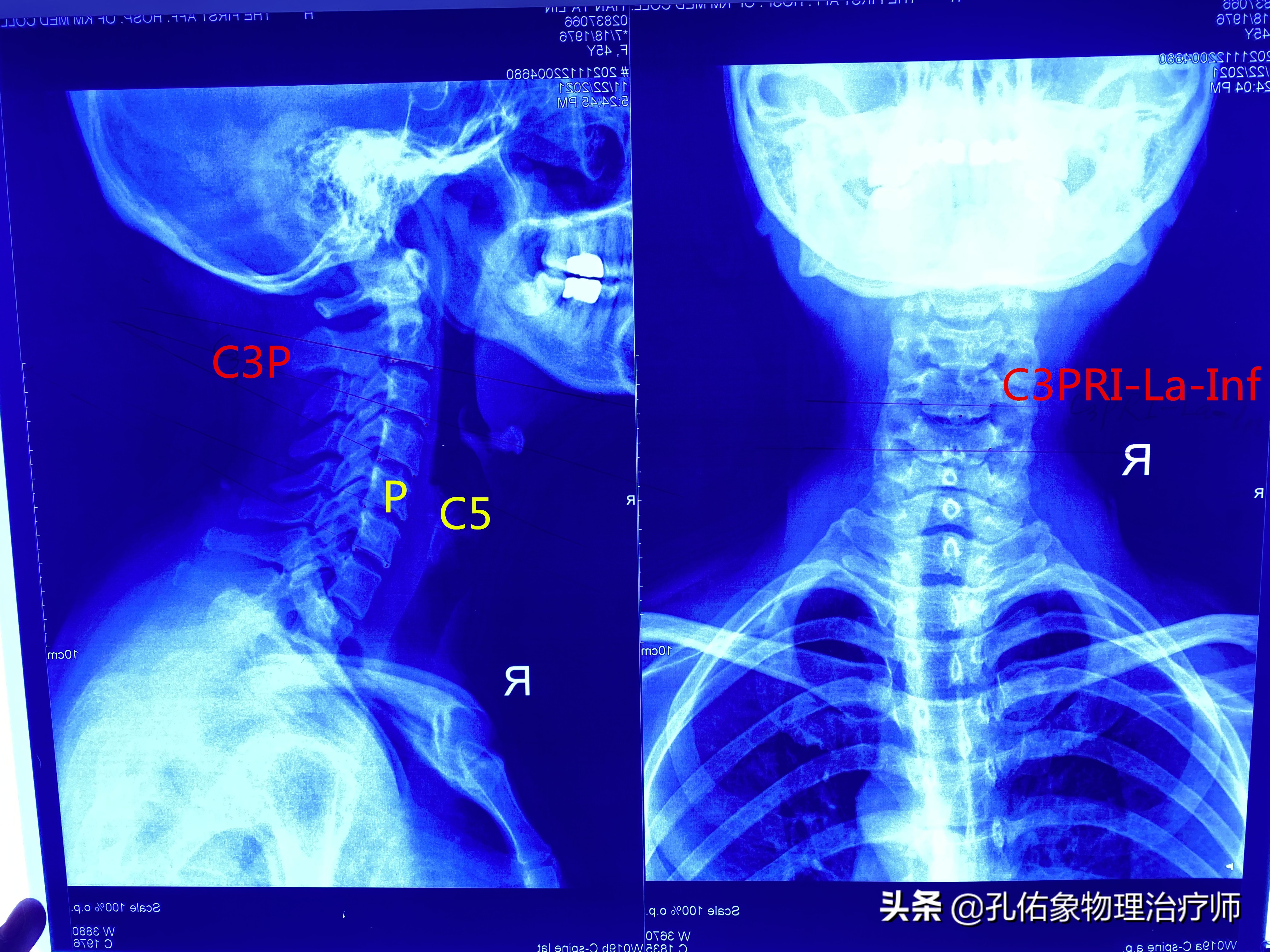 肩膀后部疼痛什么原因,肩胛骨和肩膀关节疼痛什么原因