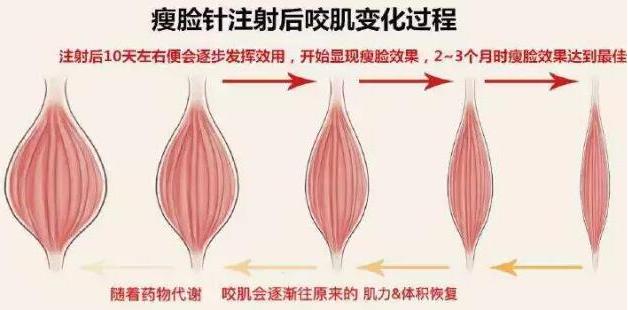 瘦脸针三针是否真的定型,瘦脸针是什么原理有副作用吗