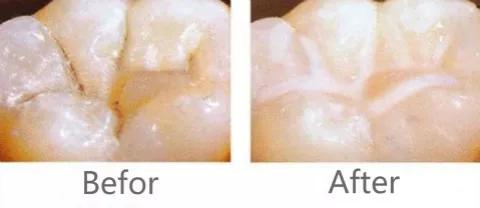 什么是儿童窝沟封闭?会不会痛?1分钟视频带你看懂#雅悦齿科#