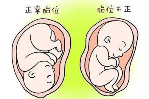顺产时发现胎位不正怎么处理,产前胎位不正怎么办怎么样能调
